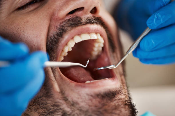 Best Emergency Dentist for Lost Fillings or Crowns in West Chester, PA